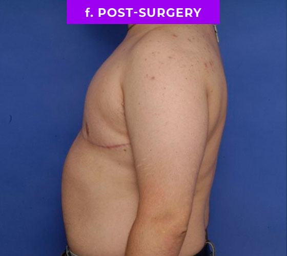 FEMALE-TO-MALE CHEST CONTOURING Patient 18 After 3