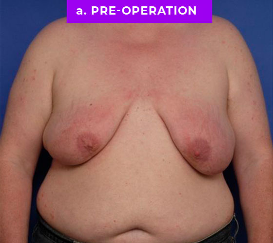 FEMALE-TO-MALE CHEST CONTOURING Patient 19 Before