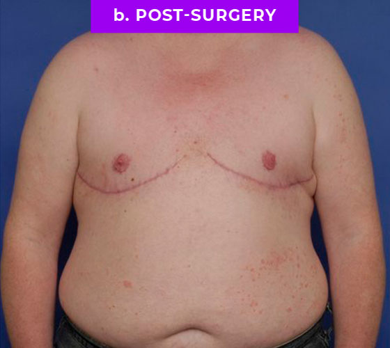 FEMALE-TO-MALE CHEST CONTOURING Patient 19 After