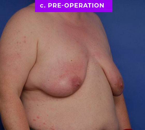 FEMALE-TO-MALE CHEST CONTOURING Patient 19 Before 2
