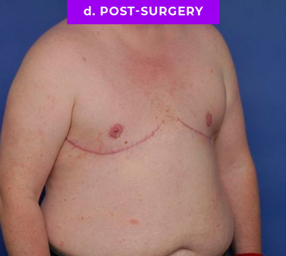 FEMALE-TO-MALE CHEST CONTOURING Patient 19 After 2