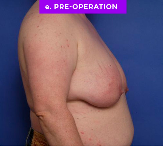 FEMALE-TO-MALE CHEST CONTOURING Patient 19 Before 3
