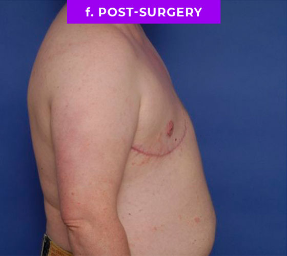 FEMALE-TO-MALE CHEST CONTOURING Patient 19 After 3