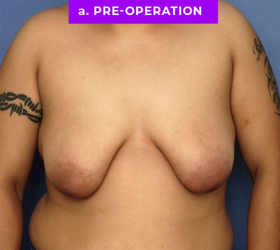 FEMALE-TO-MALE CHEST CONTOURING Patient 20 Before