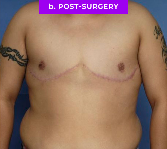 FEMALE-TO-MALE CHEST CONTOURING Patient 20 After