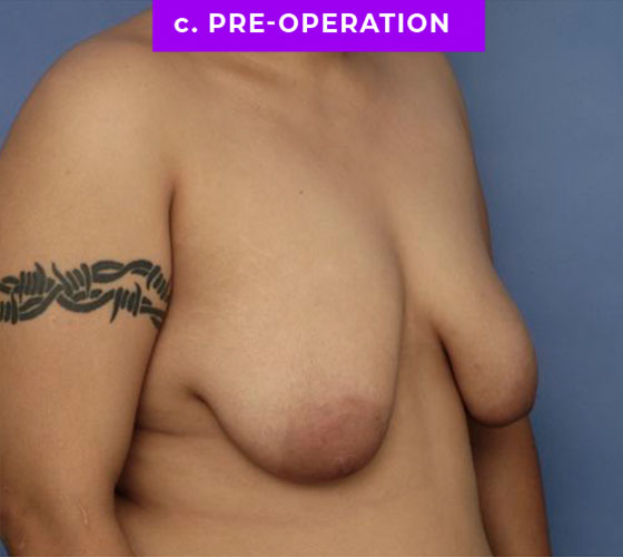 FEMALE-TO-MALE CHEST CONTOURING Patient 20 Before 2