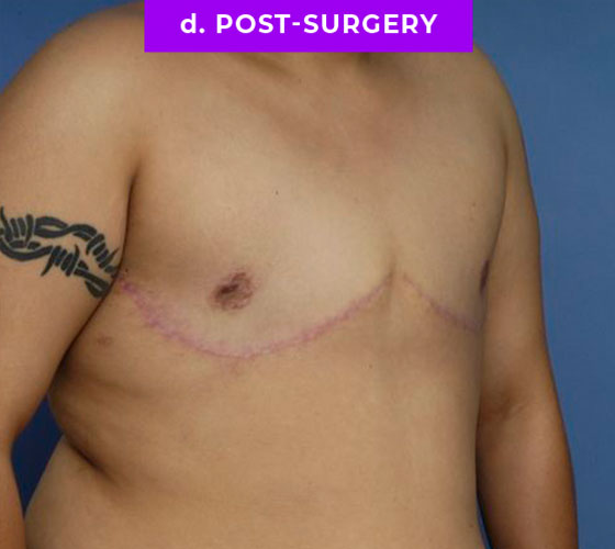 FEMALE-TO-MALE CHEST CONTOURING Patient 20 After 2