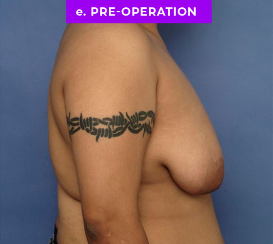 FEMALE-TO-MALE CHEST CONTOURING Patient 20 Before 3