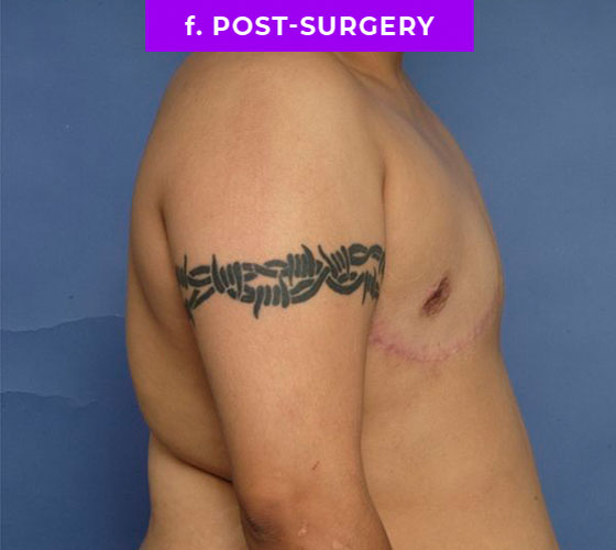 FEMALE-TO-MALE CHEST CONTOURING Patient 20 After 3