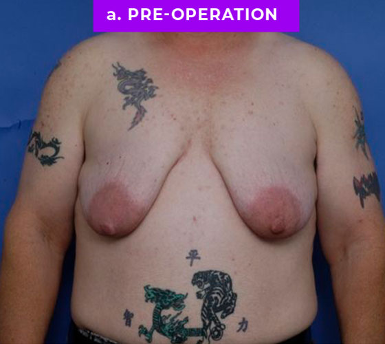 FEMALE-TO-MALE CHEST CONTOURING Patient 21 Before