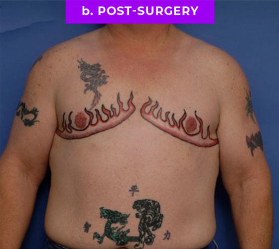 FEMALE-TO-MALE CHEST CONTOURING Patient 21 After