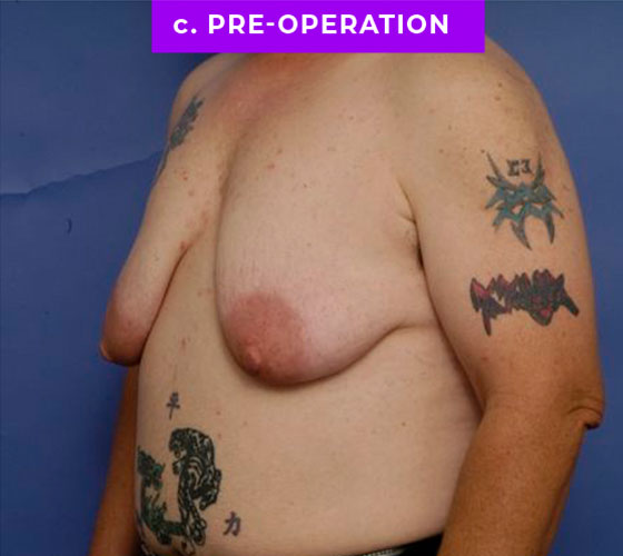 FEMALE-TO-MALE CHEST CONTOURING Patient 21 Before 2