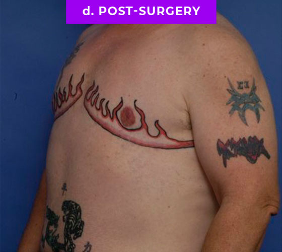 FEMALE-TO-MALE CHEST CONTOURING Patient 21 After 2