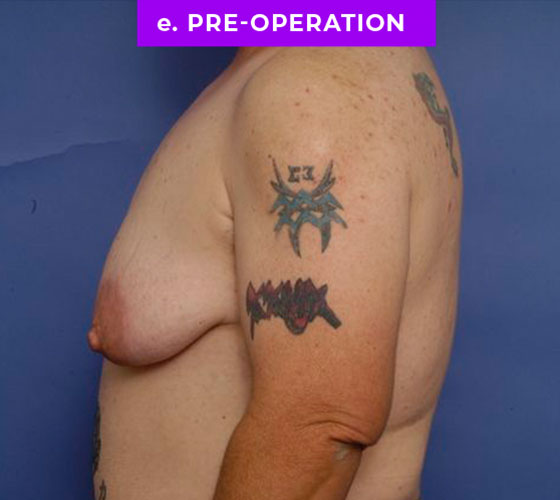 FEMALE-TO-MALE CHEST CONTOURING Patient 21 Before 3