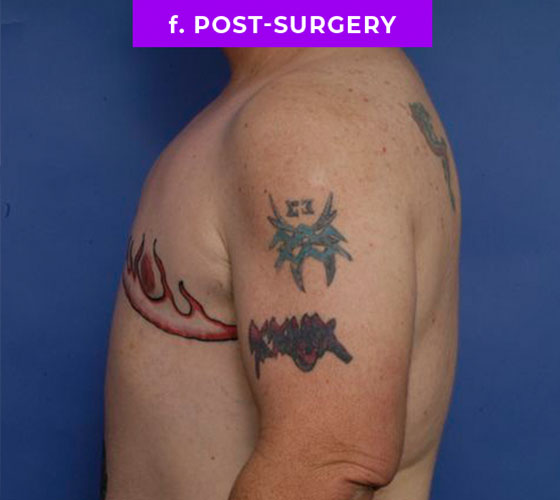 FEMALE-TO-MALE CHEST CONTOURING Patient 21 After 3