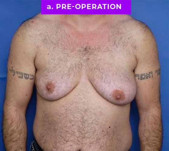 FEMALE-TO-MALE CHEST CONTOURING Patient 22 Before