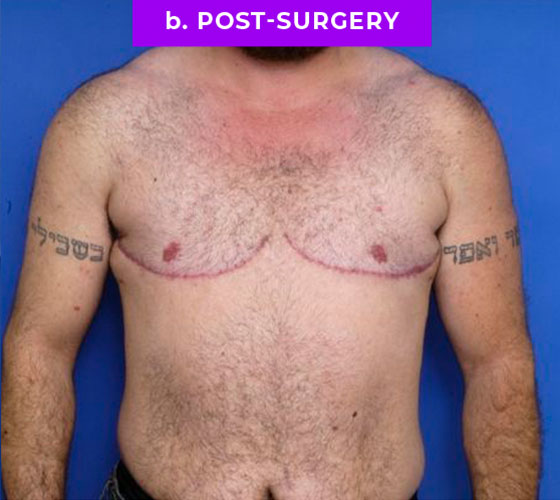 FEMALE-TO-MALE CHEST CONTOURING Patient 22 After