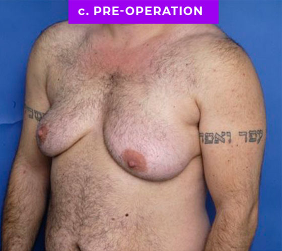 FEMALE-TO-MALE CHEST CONTOURING Patient 22 Before 2