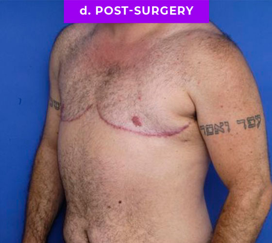 FEMALE-TO-MALE CHEST CONTOURING Patient 22 After 2