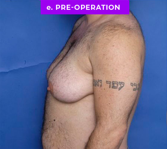 FEMALE-TO-MALE CHEST CONTOURING Patient 22 Before 3