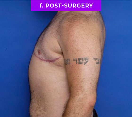 FEMALE-TO-MALE CHEST CONTOURING Patient 22 After 3