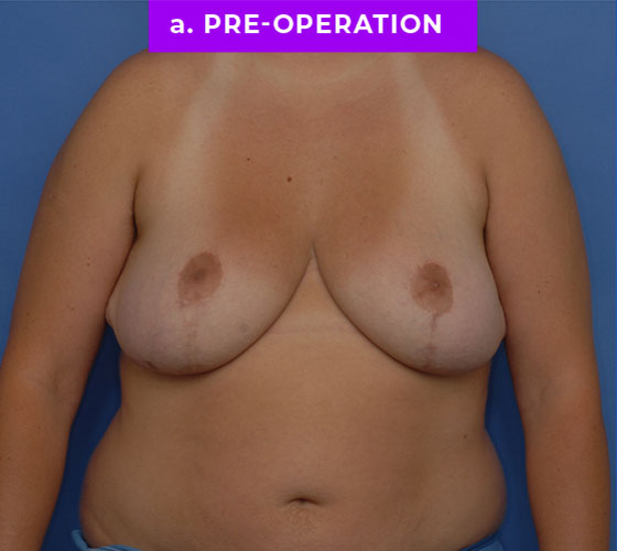 FEMALE-TO-MALE CHEST CONTOURING Patient 23 Before