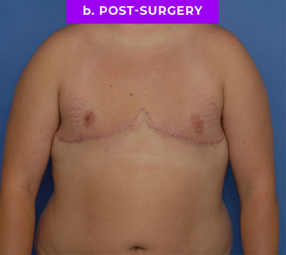 FEMALE-TO-MALE CHEST CONTOURING Patient 23 After