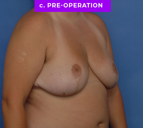 FEMALE-TO-MALE CHEST CONTOURING Patient 23 Before 2