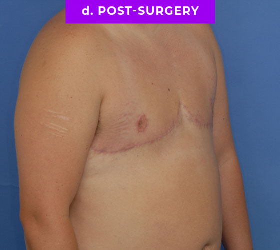 FEMALE-TO-MALE CHEST CONTOURING Patient 23 After 2