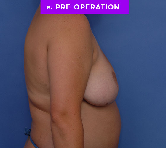 FEMALE-TO-MALE CHEST CONTOURING Patient 23 Before 3