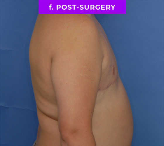 FEMALE-TO-MALE CHEST CONTOURING Patient 23 After 3
