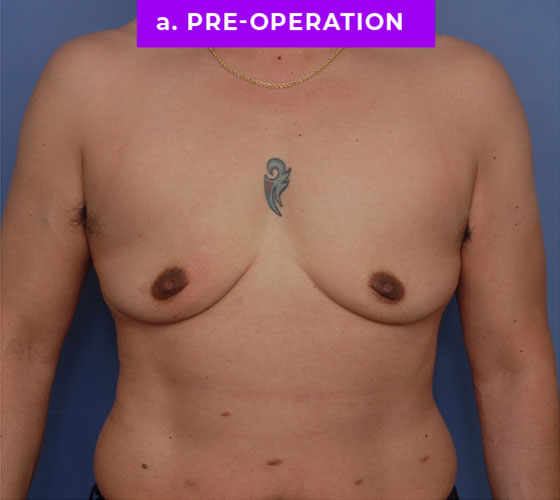 FEMALE-TO-MALE CHEST CONTOURING Patient 24 Before