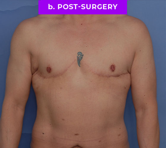 FEMALE-TO-MALE CHEST CONTOURING Patient 24 After