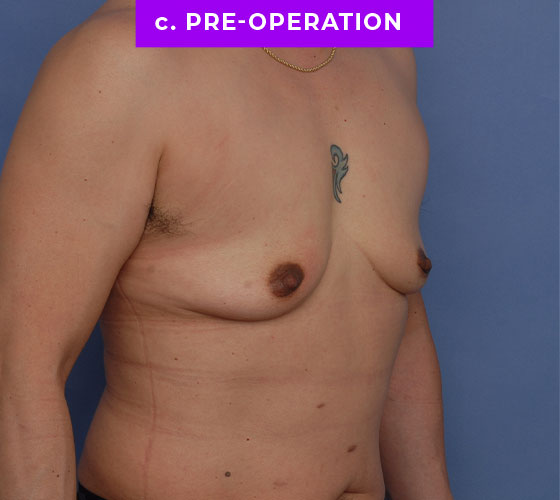 FEMALE-TO-MALE CHEST CONTOURING Patient 24 Before 2