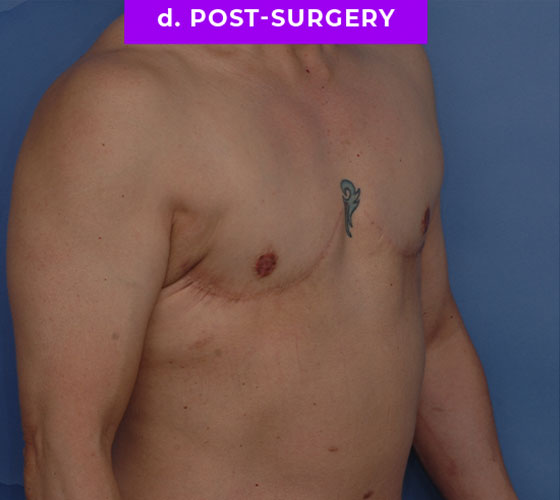 FEMALE-TO-MALE CHEST CONTOURING Patient 24 After 2