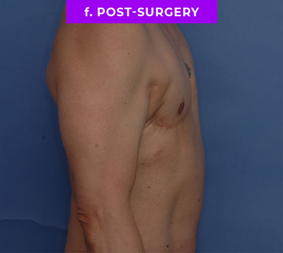 FEMALE-TO-MALE CHEST CONTOURING Patient 24 After 3