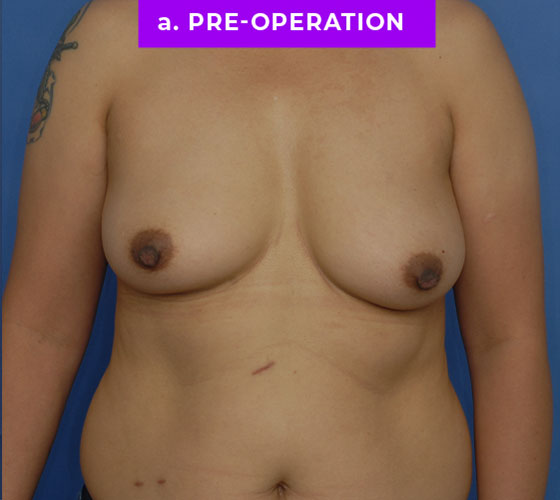 FEMALE-TO-MALE CHEST CONTOURING Patient 25 Before