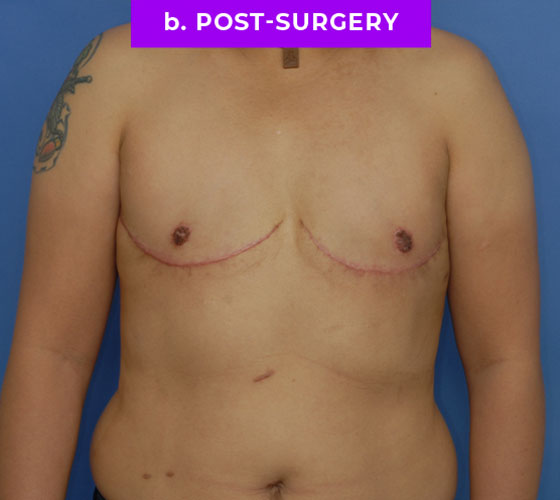 FEMALE-TO-MALE CHEST CONTOURING Patient 25 After