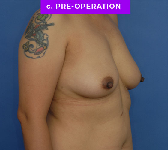 FEMALE-TO-MALE CHEST CONTOURING Patient 25 Before 2