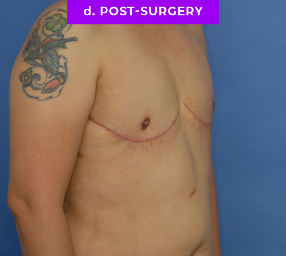 FEMALE-TO-MALE CHEST CONTOURING Patient 25 After 2