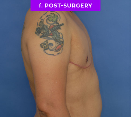FEMALE-TO-MALE CHEST CONTOURING Patient 25 After 3
