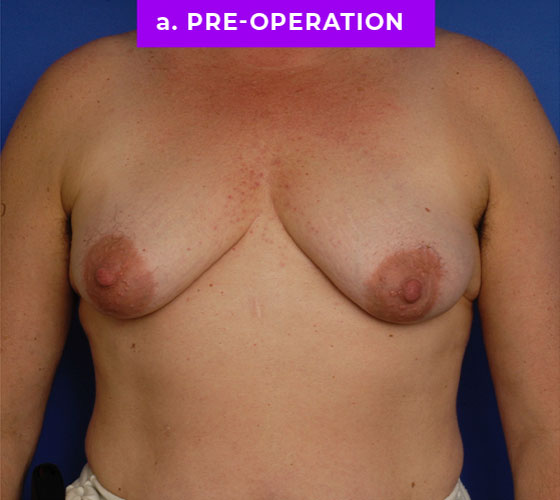 FEMALE-TO-MALE CHEST CONTOURING Patient 26 Before