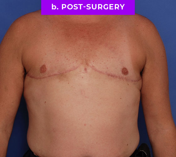 FEMALE-TO-MALE CHEST CONTOURING Patient 26 After