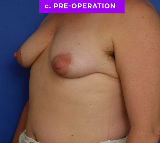 FEMALE-TO-MALE CHEST CONTOURING Patient 26 Before 2