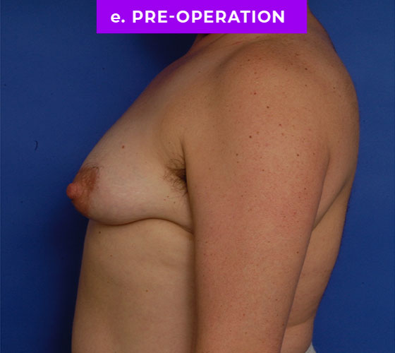 FEMALE-TO-MALE CHEST CONTOURING Patient 26 Before 3