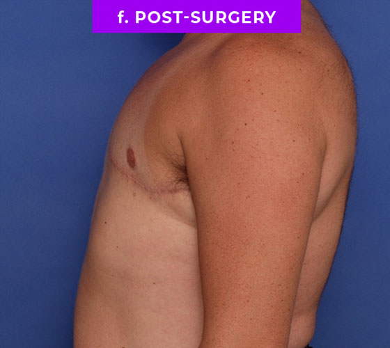FEMALE-TO-MALE CHEST CONTOURING Patient 26 After 3