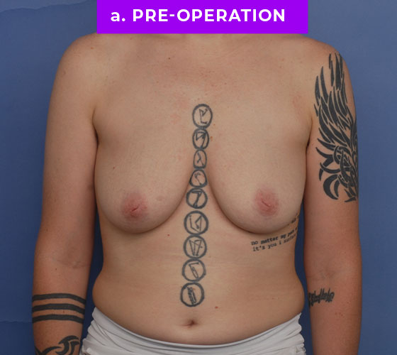 FEMALE-TO-MALE CHEST CONTOURING Patient 27 Before