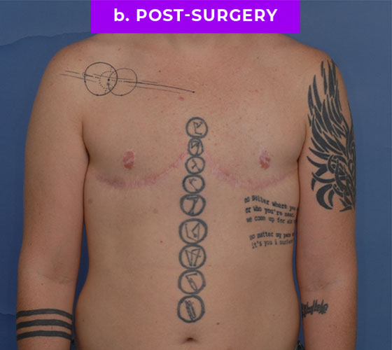 FEMALE-TO-MALE CHEST CONTOURING Patient 27 After