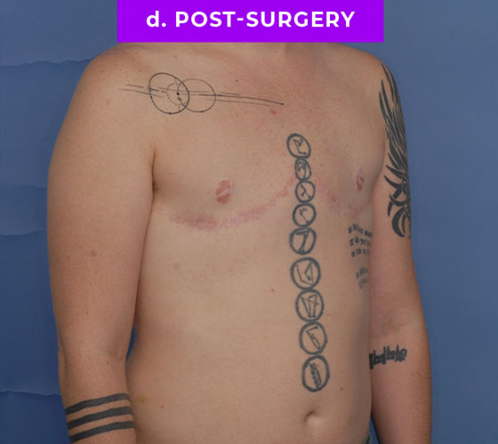 FEMALE-TO-MALE CHEST CONTOURING Patient 27 After 2