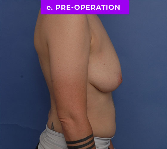 FEMALE-TO-MALE CHEST CONTOURING Patient 27 Before 3